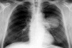 Tumore al polmone: il via libera dell’Ue per una nuova terapia mirata