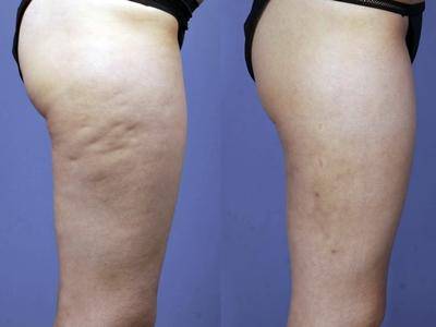 Cellulite, come farci i conti