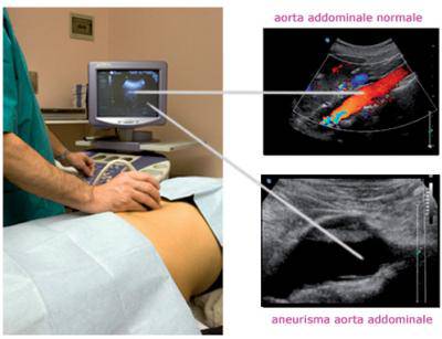 Aneurisma Aorta Addominale, giornate per la prevenzione