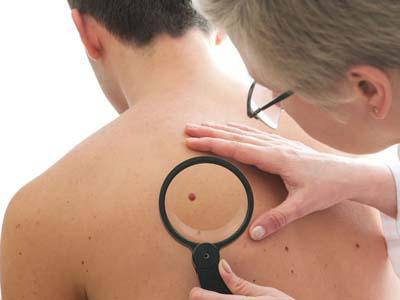 Prevenzione del melanoma: che cos’è il melanoma e come prevenirlo