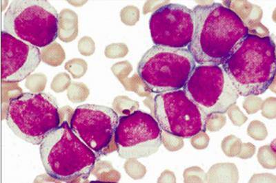 Leucemia mieloide cronica, AIL: “Guarisce il 51,6% dei pazienti”