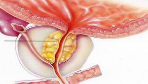 Tumore a prostata, rene e vescica: dove operarsi in Lazio?