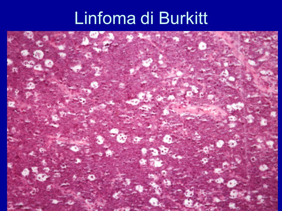 linfoma burkitt