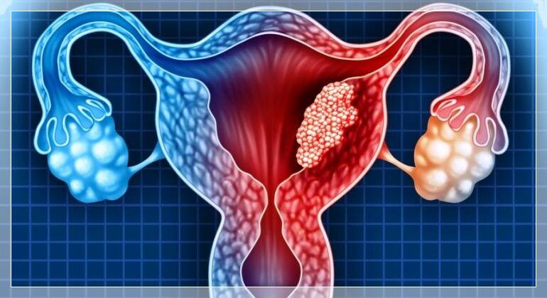 Tumori, una nuova strategia per mettere il freno al cancro dell’ovaio